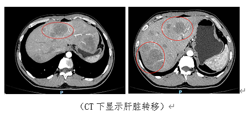 揪心！亲姐刚患癌去世，29岁小伙也确诊相同癌症晚期！医生紧急提醒：子女有50%患病率（组图） - 2