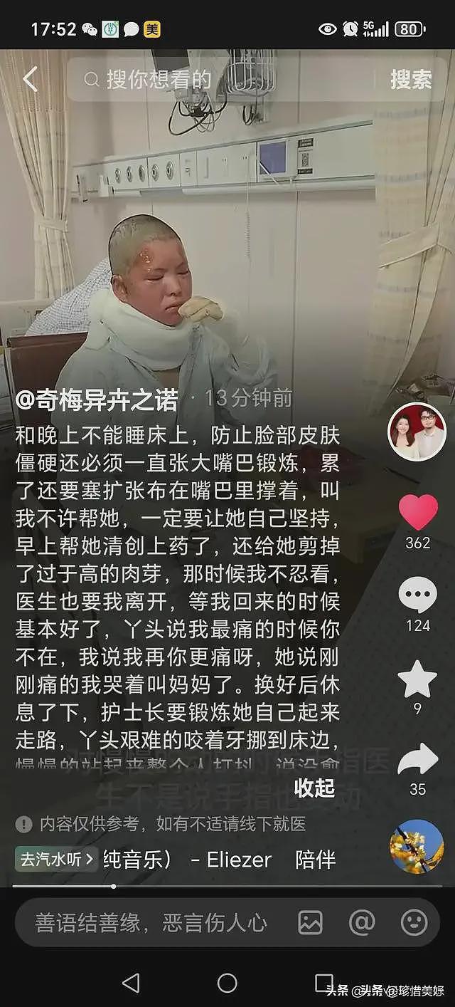 烧伤妈妈第一次露脸，没有毁容，咬牙锻炼坐马桶，需一直张大嘴巴（组图） - 8