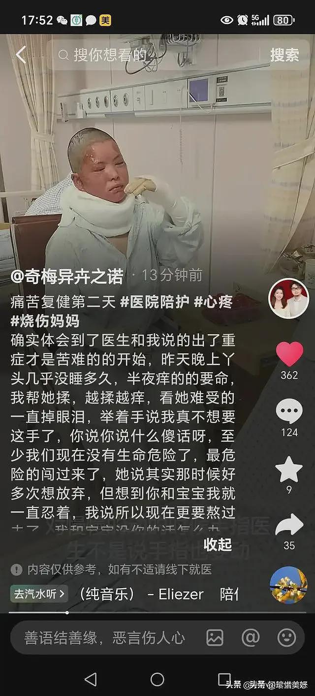 烧伤妈妈第一次露脸，没有毁容，咬牙锻炼坐马桶，需一直张大嘴巴（组图） - 6