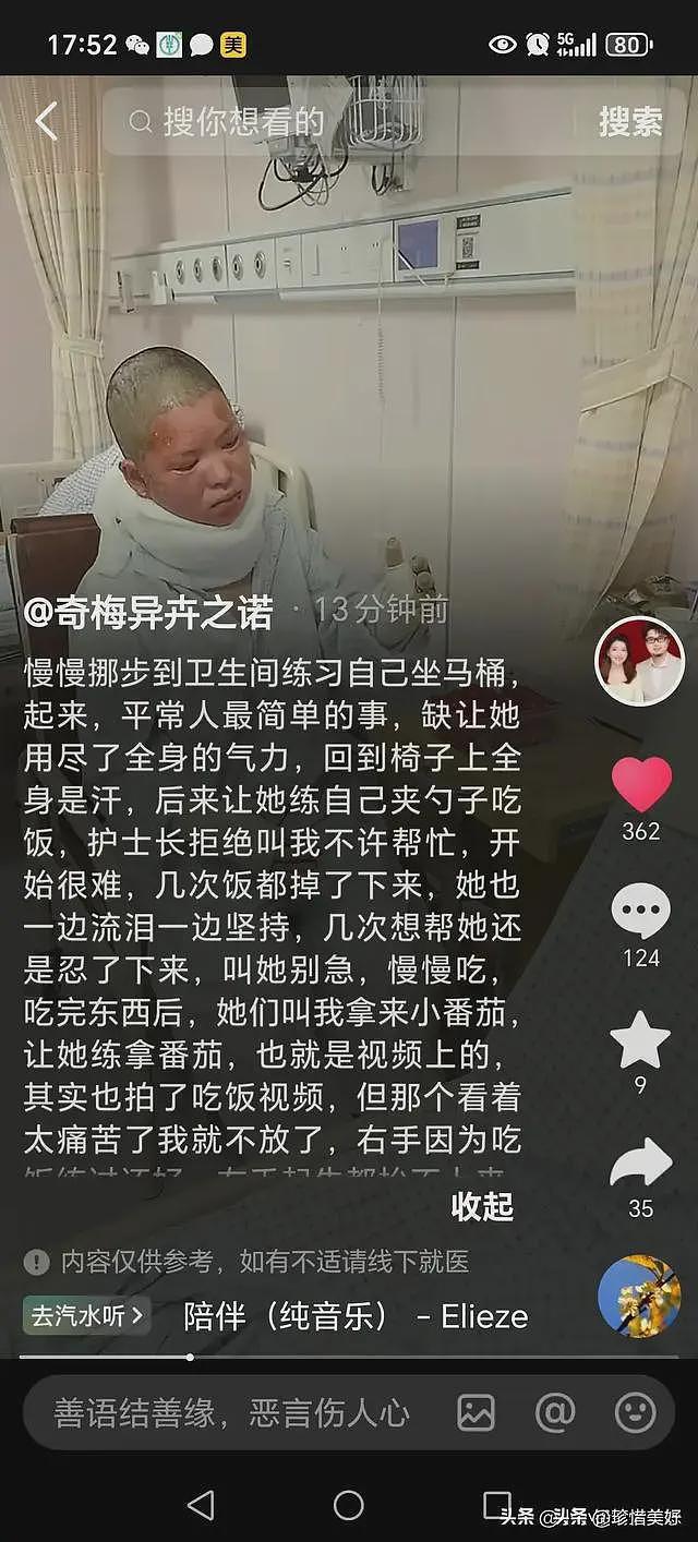 烧伤妈妈第一次露脸，没有毁容，咬牙锻炼坐马桶，需一直张大嘴巴（组图） - 9