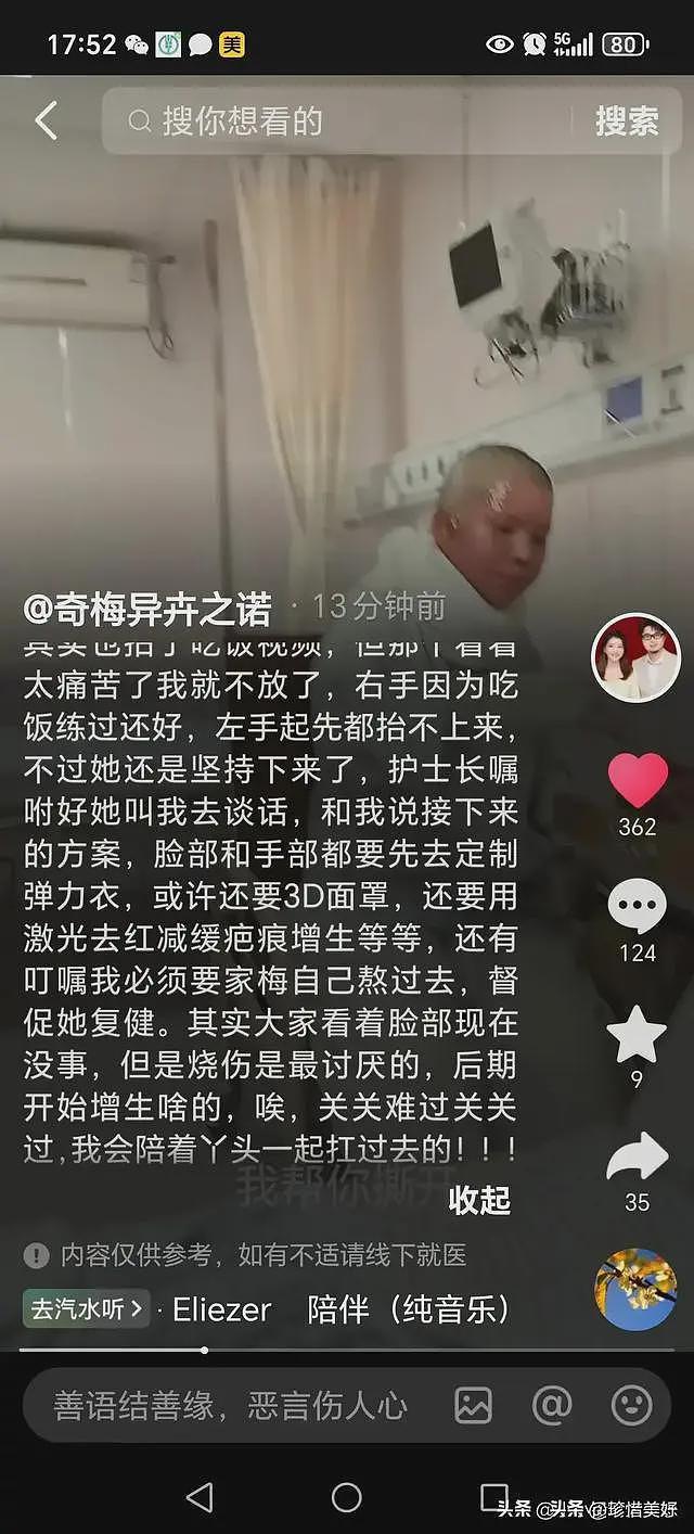 烧伤妈妈第一次露脸，没有毁容，咬牙锻炼坐马桶，需一直张大嘴巴（组图） - 10