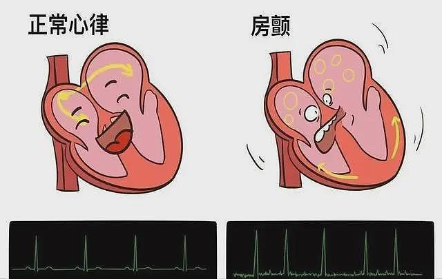 【健康】上海交大解剖203名脑梗死者，惊讶发现患脑梗的人，有3大特点（组图） - 5