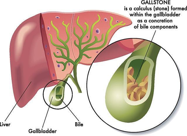 【健康】中国胆囊癌高发，罪魁祸首被揪出！提醒：有这些吃饭习惯，尽早改（组图） - 1
