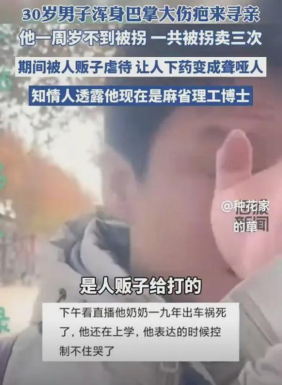 30岁麻省理工博士寻亲！被毒聋哑卖3次，浑身都是巴掌大的伤疤（组图） - 7