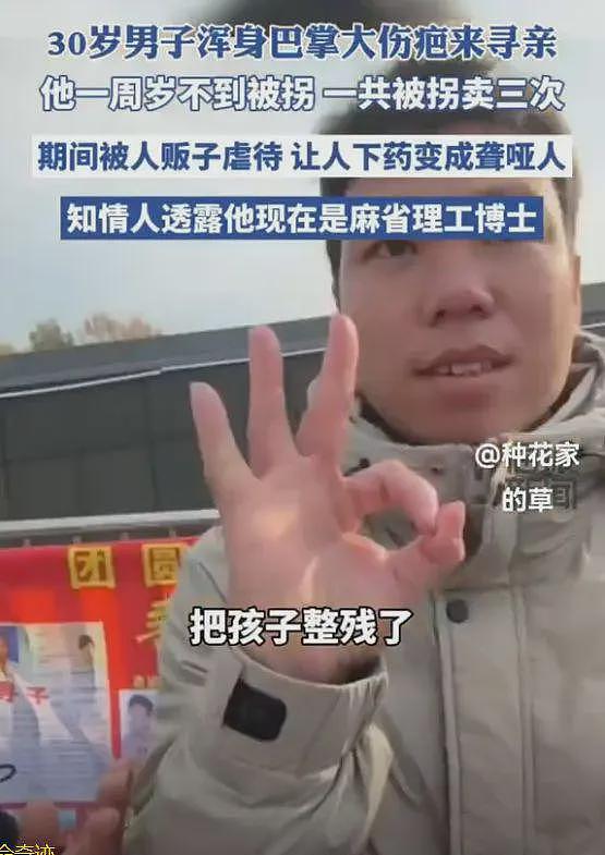 30岁麻省理工博士寻亲！被毒聋哑卖3次，浑身都是巴掌大的伤疤（组图） - 2