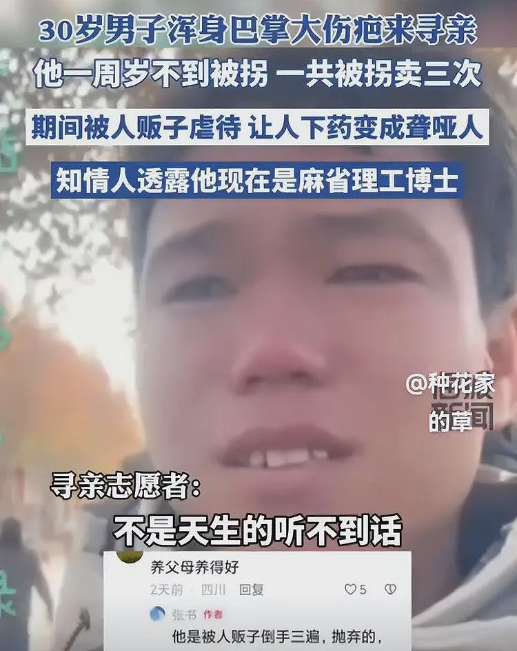 30岁麻省理工博士寻亲！被毒聋哑卖3次，浑身都是巴掌大的伤疤（组图） - 4