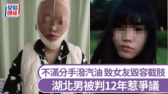 湖北男子不满分手泼汽油！致女友全身7成烧伤毁容截肢恐怖画面曝（视频/组图） - 1