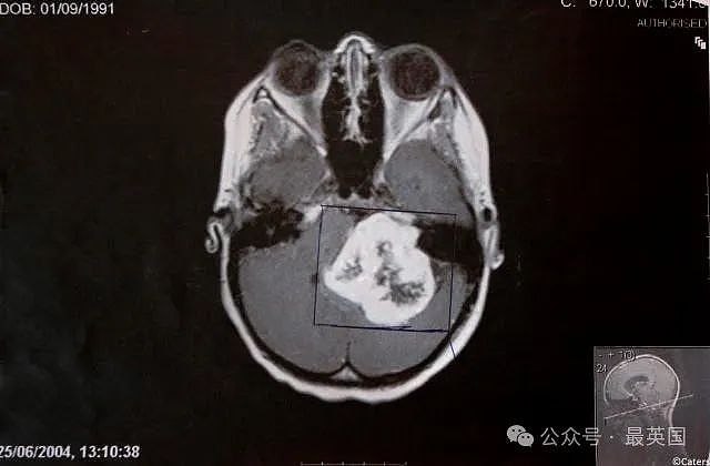 过山车撞出了脑瘤？英国女童坐完过山车，竟帮她提前发现了癌症！类似例子已屡见不鲜…（组图） - 11