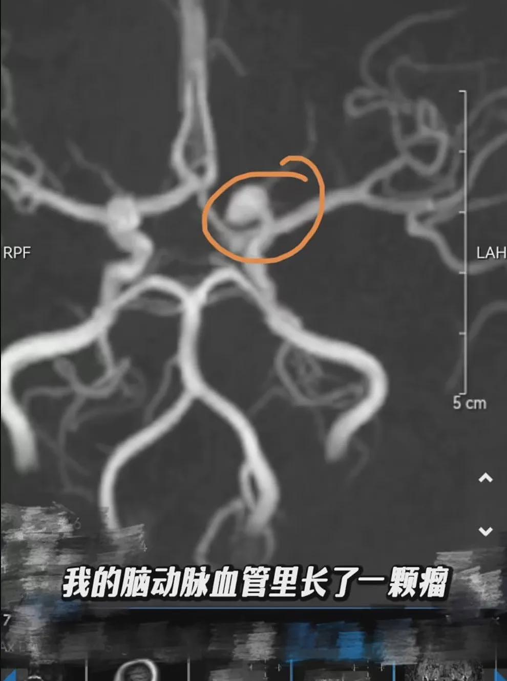 知名女星哽咽自曝“已生化“！这种病平常或无症状，一旦发作严重可致死（组图） - 3