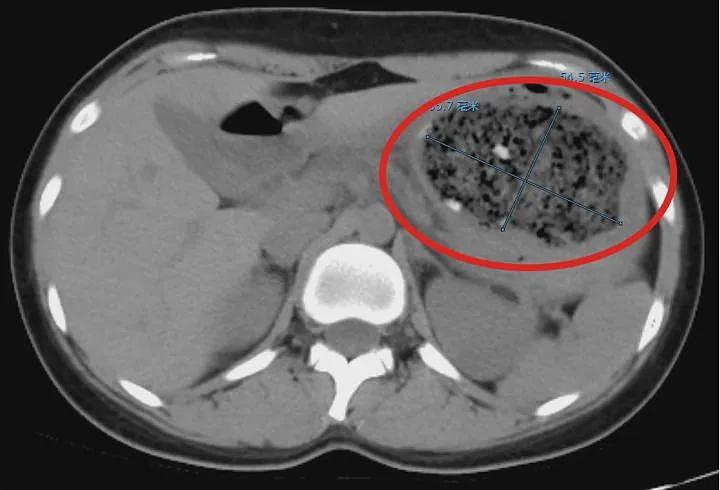 近期大量上市，杭州大二女生吃了1斤多，痛到满地打滚！一查CT胃里密密麻麻……（组图） - 1
