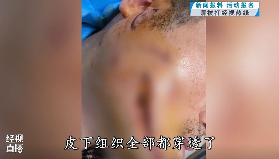 武汉男跟影片学“狗语”训犬，脸惨遭咬穿！医生：与狗对话有风险（组图） - 2