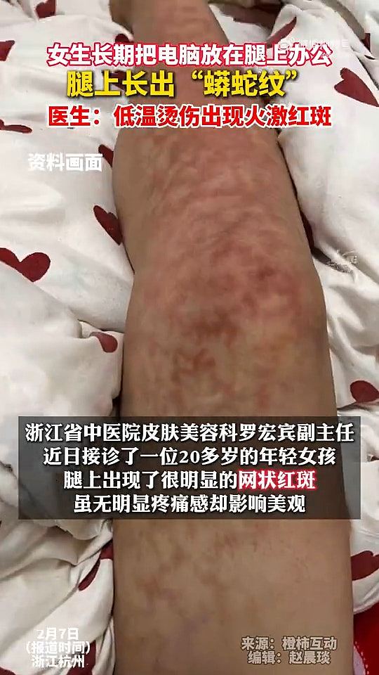 女子大腿长出“红色蟒蛇纹”！求医后原来系手提电脑放腿上惹祸（组图） - 2