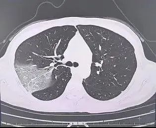 突然确诊，女子硬扛3天，肺都变“白”了！医生：传染性更强、症状更严重（组图） - 1