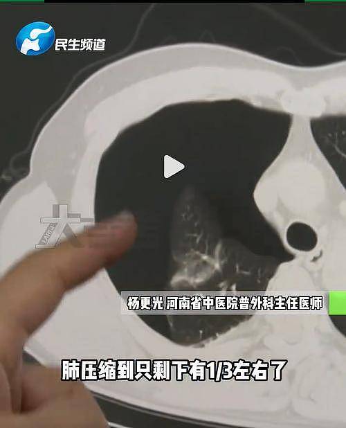 河南一男子节后减肥做20个俯卧撑，结果“肺炸“了（组图） - 2