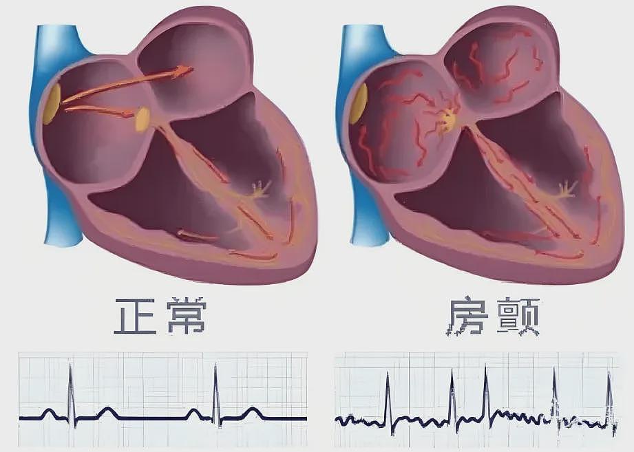 【健康】中国房颤人数居亚太之首，5类人尤其应警惕（组图） - 3