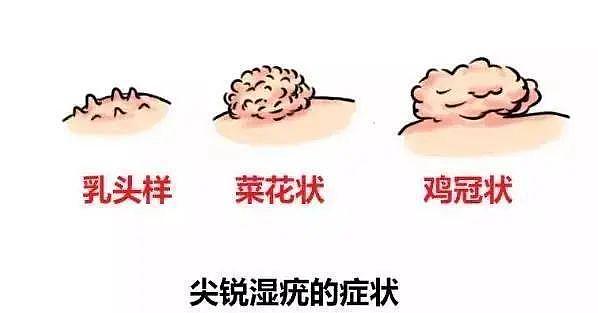 45岁男子生殖器长出“菜花”，在医院他懊悔不已...（图） - 1