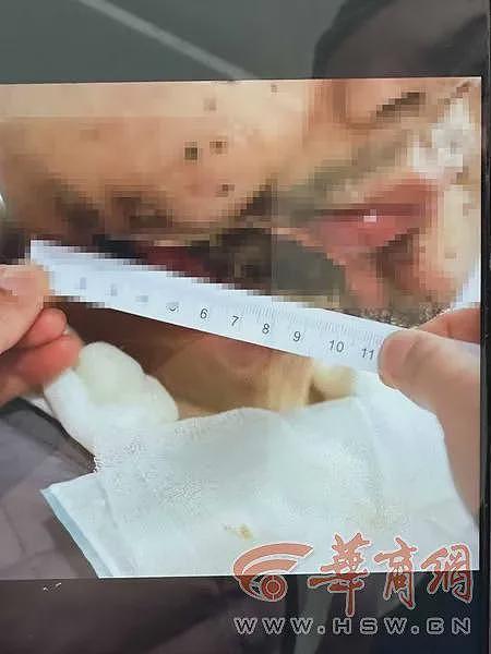 老朋友说能治癌 ，开了43.5万元的药，男子吃了5个月后“半张脸没了”（组图） - 4