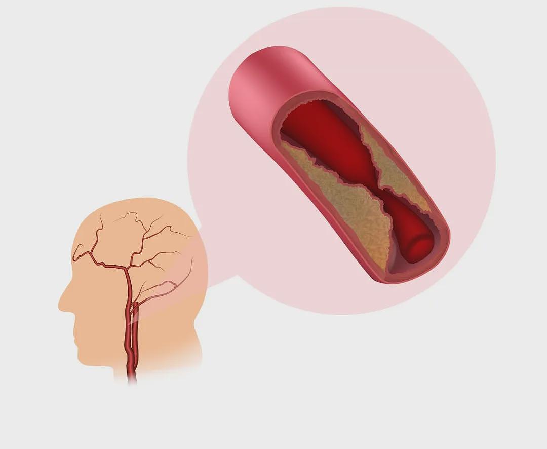 小心！60岁后，颈动脉几乎100%会长斑块！这样做能逆转（组图） - 1