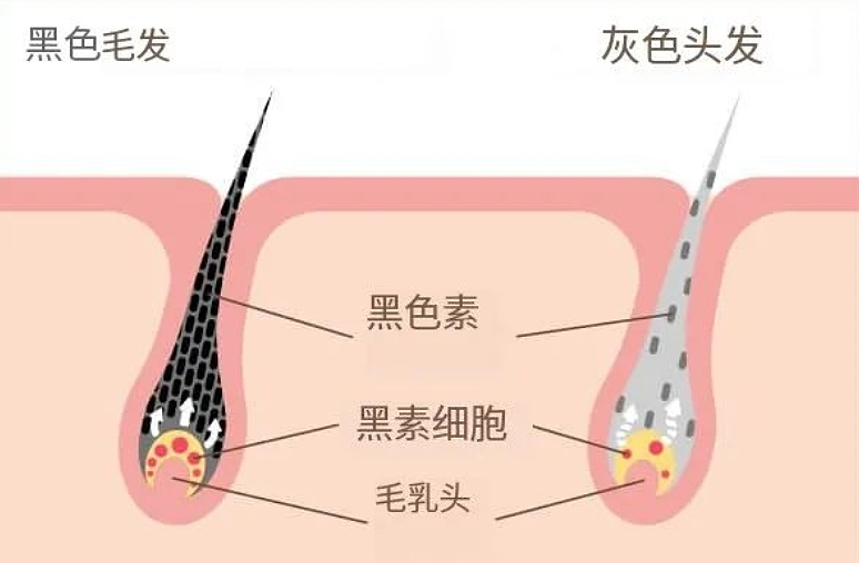 头发白了，还能变黑吗？医生的答案出乎意料（组图） - 2