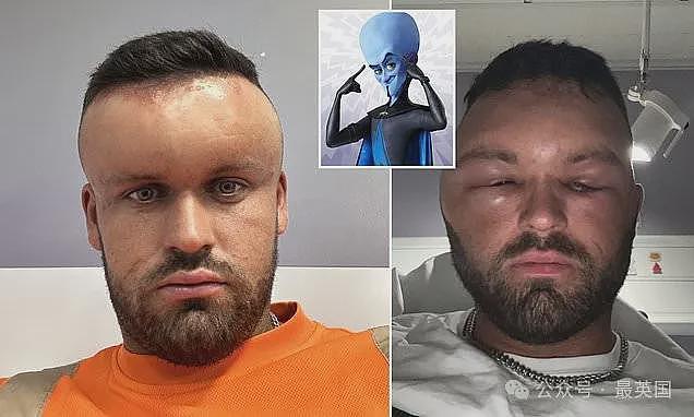英国小伙只是染个发，差点要了命！脑袋直接肿成了大气球…（组图） - 16