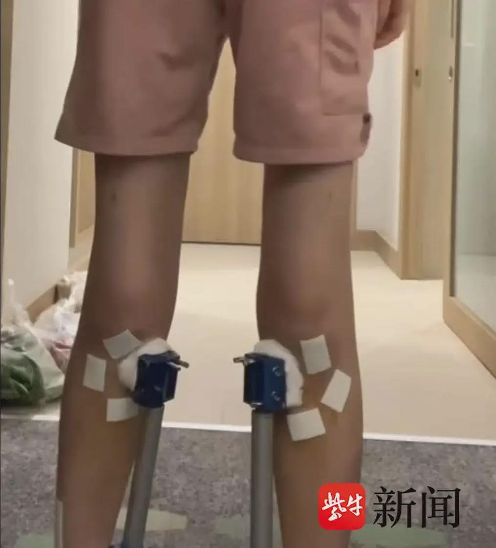 女子花60万去国外“断骨增高”13厘米，后遗症缠身（组图） - 2