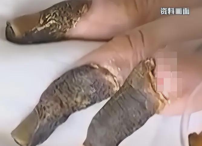 广东男孩实验爆炸后续：将截肢右眼全瞎，住房4万1平经济压力还大（组图） - 1