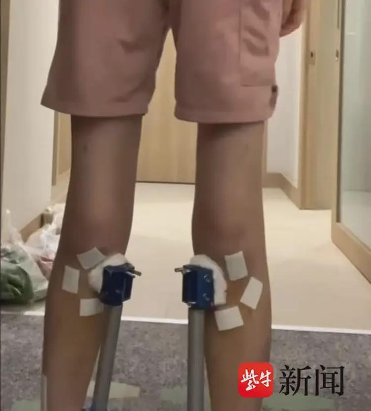 女子花60万去国外“断骨增高”13cm，后遗症缠身维权艰难（组图） - 2