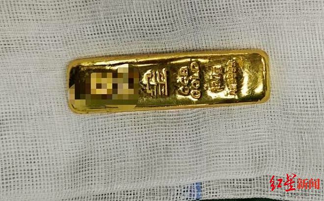 11岁男孩误吞100克金条2天后取出，治疗医生：金条细长（图） - 1