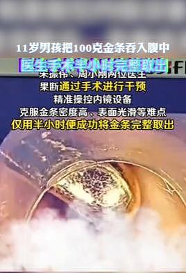 11岁男孩误吞100克金条2天后取出，治疗医生：金条细长（图） - 3