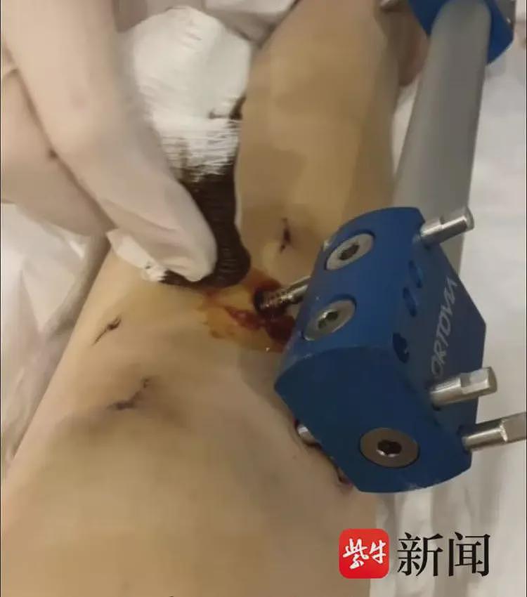 女子花60万去国外“断骨增高”13cm，后遗症缠身维权艰难（组图） - 1