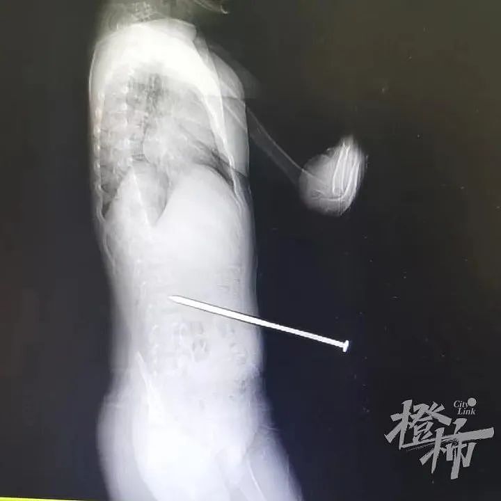 太险了！6岁男孩瞬间被长钉插入腰部！多地明确禁止（组图） - 4