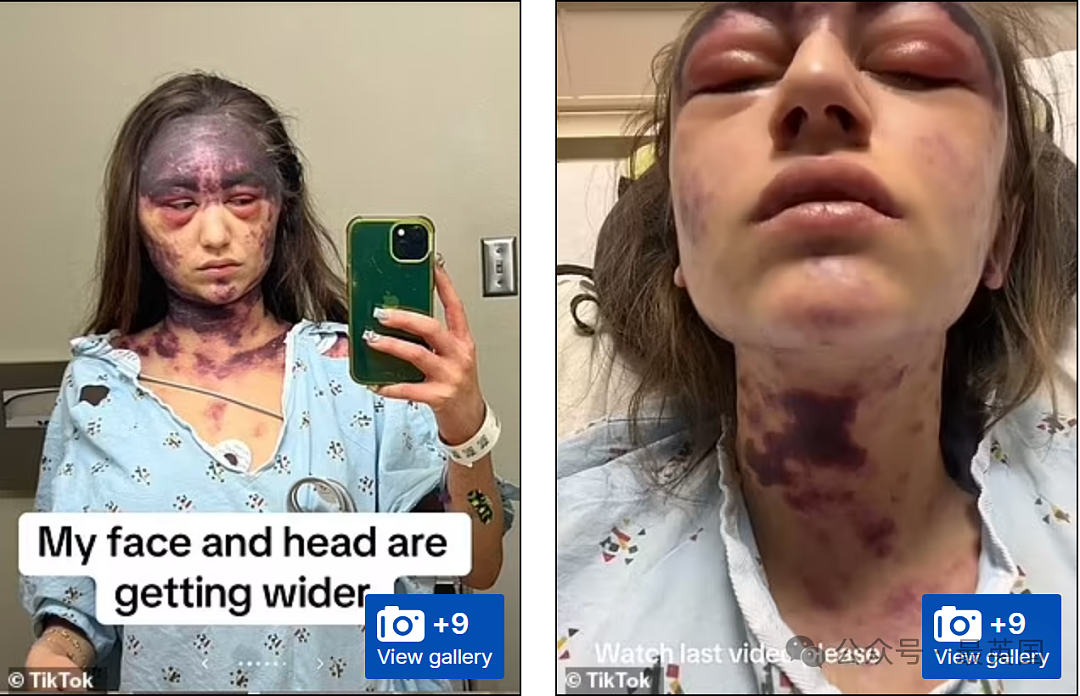 美女被医院强制打3针y苗后突发失明！全身淤黑剧烈肿胀、面目全非！医生却开始甩锅（组图） - 4