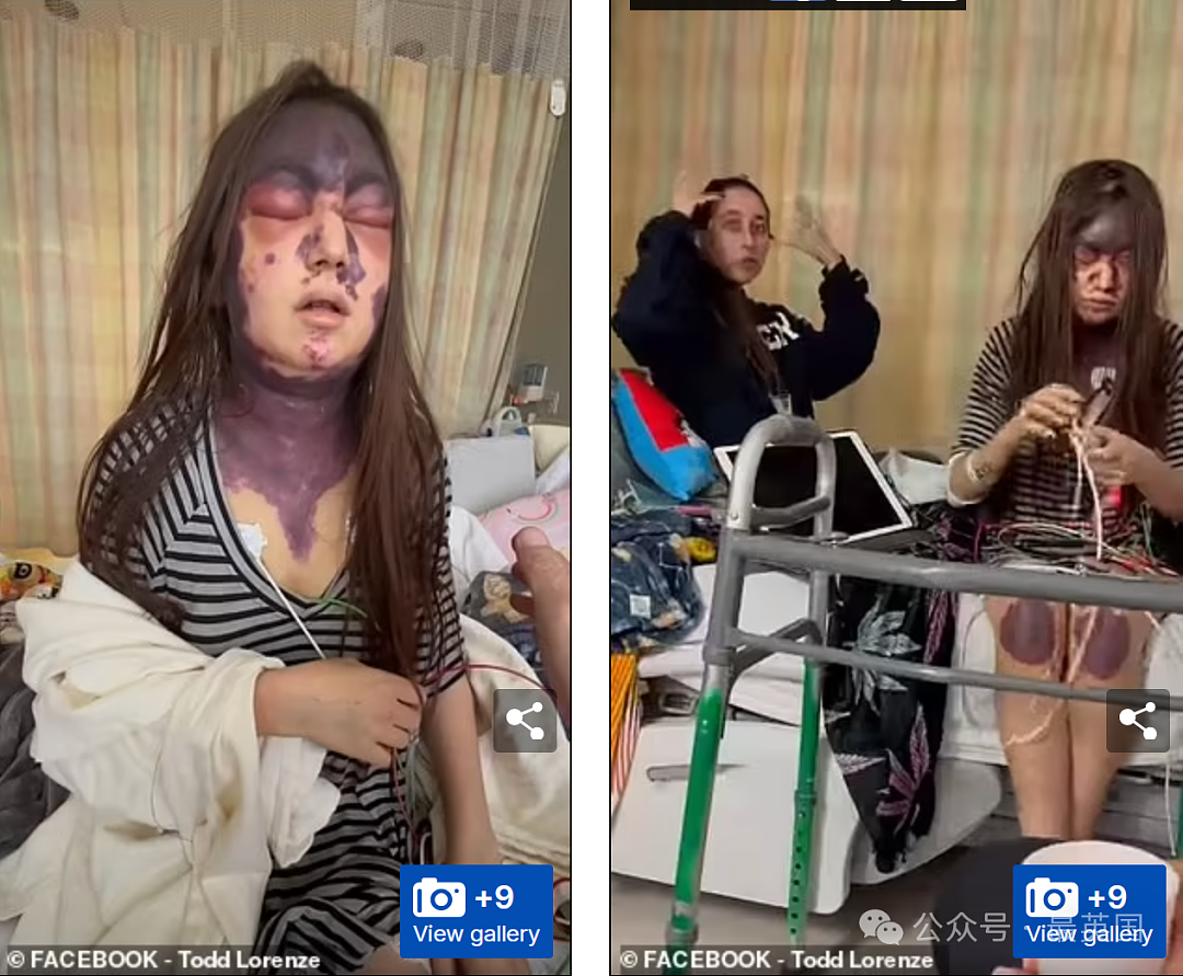 美女被医院强制打3针y苗后突发失明！全身淤黑剧烈肿胀、面目全非！医生却开始甩锅（组图） - 2