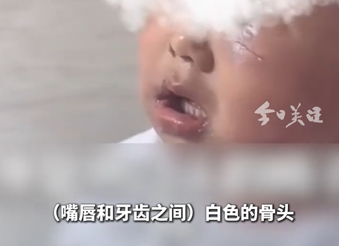 “多处撕裂，骨头已露出”！医生视频举报3岁男童疑遭虐待，警方已立案（视频/组图） - 1