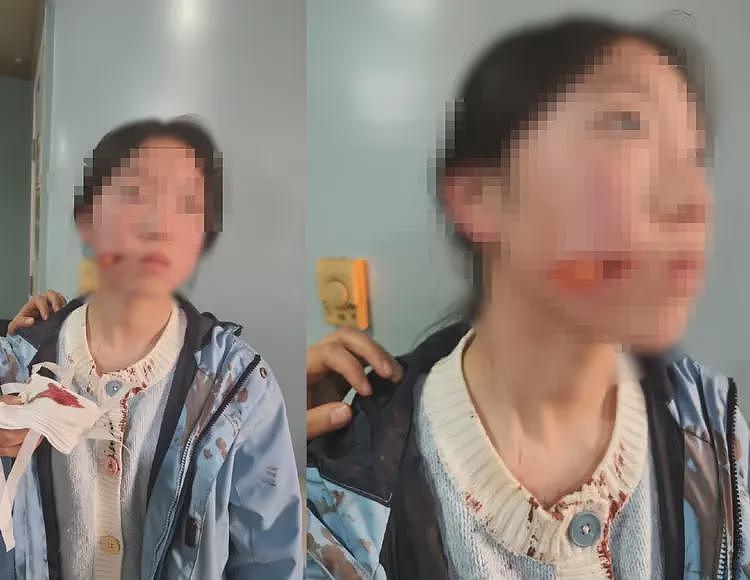 网传西安一女中学生，脸部被刀砍到皮开肉绽，当地派出所：伤人者不满15岁不予立案（组图） - 1