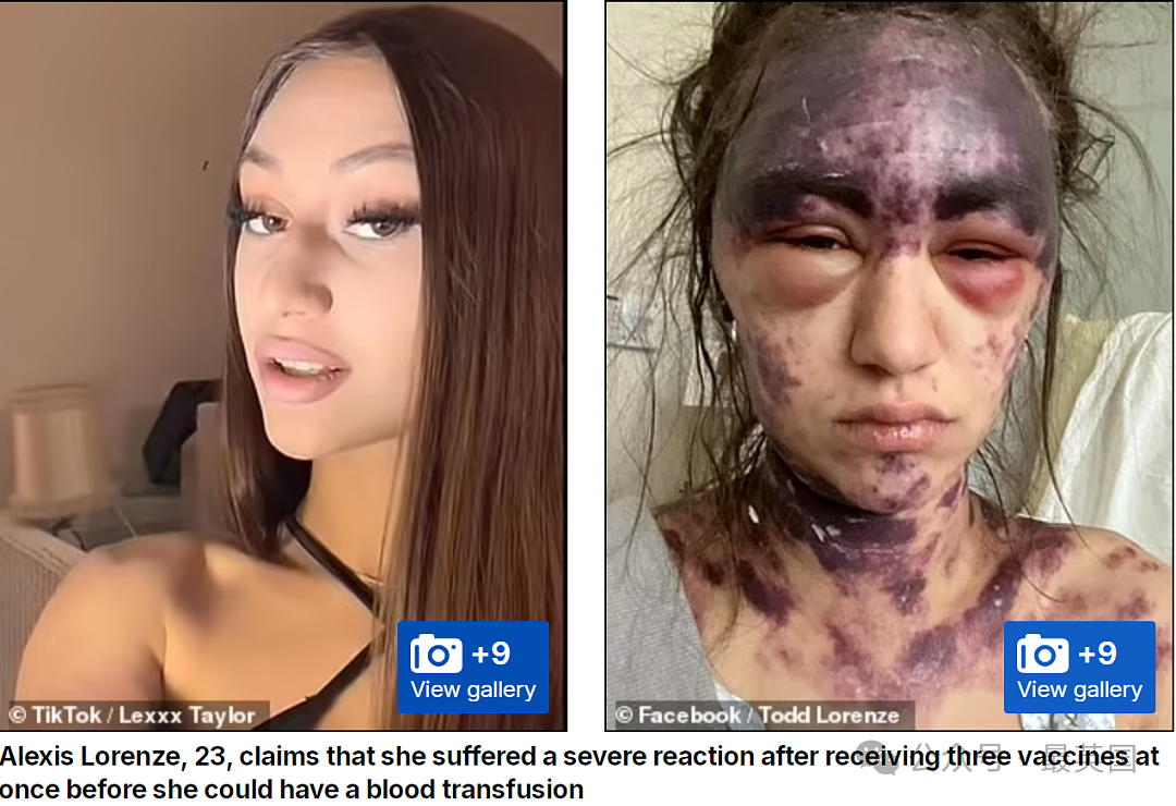美女被医院强制打3针y苗后突发失明！全身淤黑剧烈肿胀、面目全非！医生却开始甩锅（组图） - 6