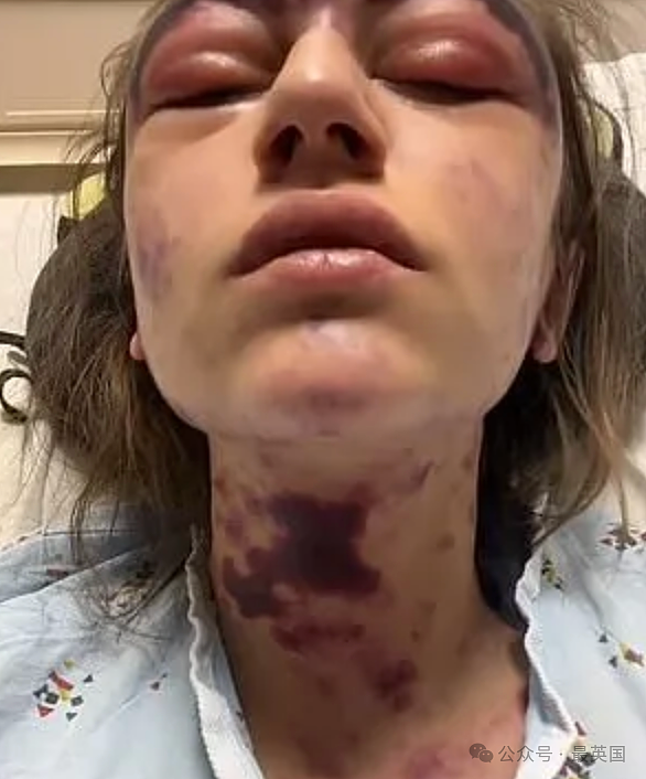 美女被医院强制打3针y苗后突发失明！全身淤黑剧烈肿胀、面目全非！医生却开始甩锅（组图） - 7