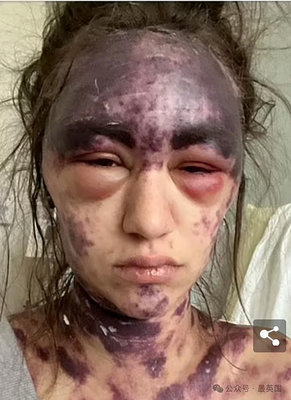 美女被医院强制打3针y苗后突发失明！全身淤黑剧烈肿胀、面目全非！医生却开始甩锅（组图） - 5