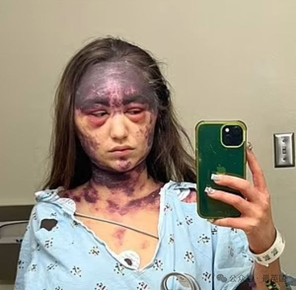 美女被医院强制打3针y苗后突发失明！全身淤黑剧烈肿胀、面目全非！医生却开始甩锅（组图） - 8