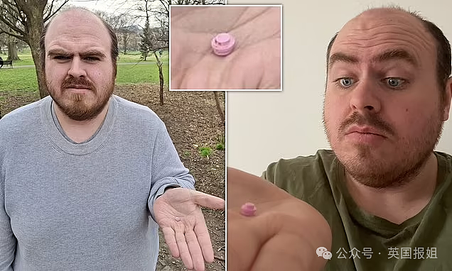 英男子左耳剧痛多年差点失聪,睡一觉竟抠出“包浆”玩具零件!医生:藏了20几年(组图) - 1