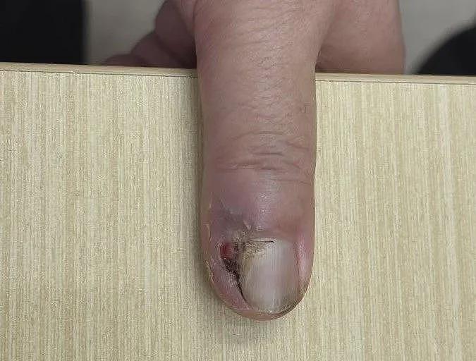 指甲长出怪东西，拔甲数次无效！医生切开后惊了：竟是癌症（组图） - 1
