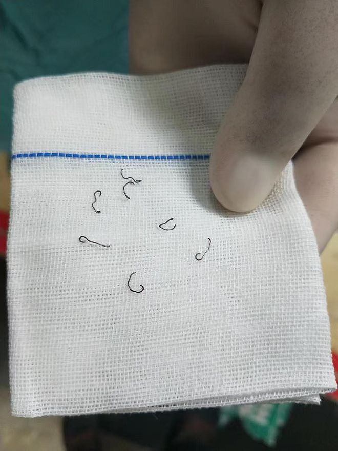 女子做痔疮手术留“隐患”：10年8次手术取出30多枚钛钉；法院判赔62万（组图） - 1