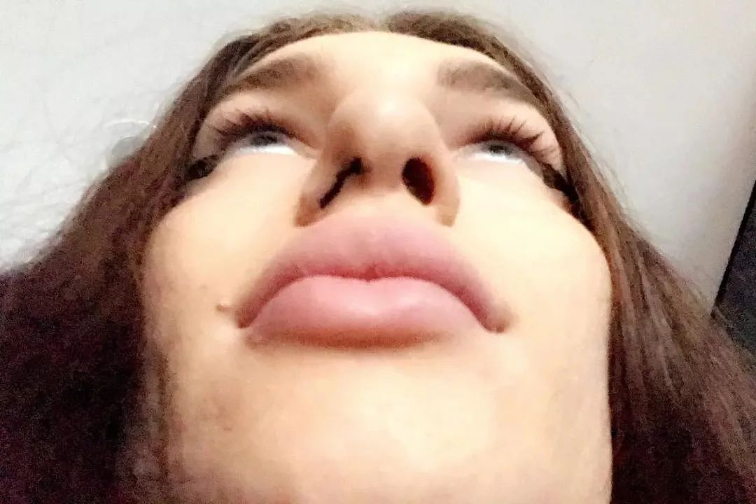 澳洲变性网红先变真人娃娃缝死肚脐，又整成猫女！如今一挤脸就流填充物，后悔了...（组图） - 8