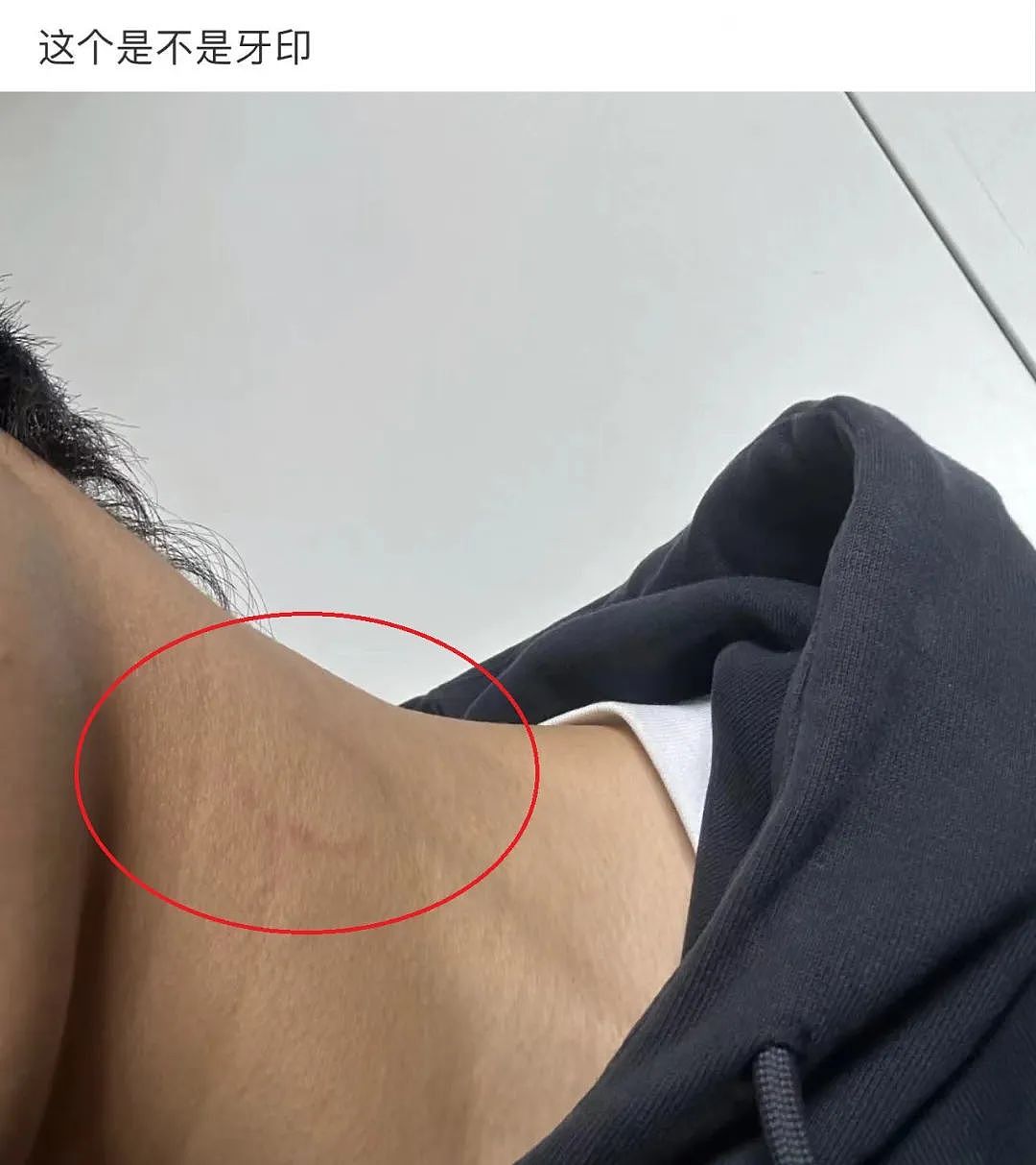 【爆笑】在男朋友脖子上发现一个比吻痕更可怕的牙印！因为这个痕迹，我连她是啥脸型都猜出来了...（组图） - 2