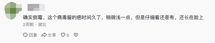 中国妹纸发视频引中美网友一片惊恐！就因KTV唱歌话筒太靠近脸，她从此染上“不治之症”8年后仍被折磨（组图） - 25