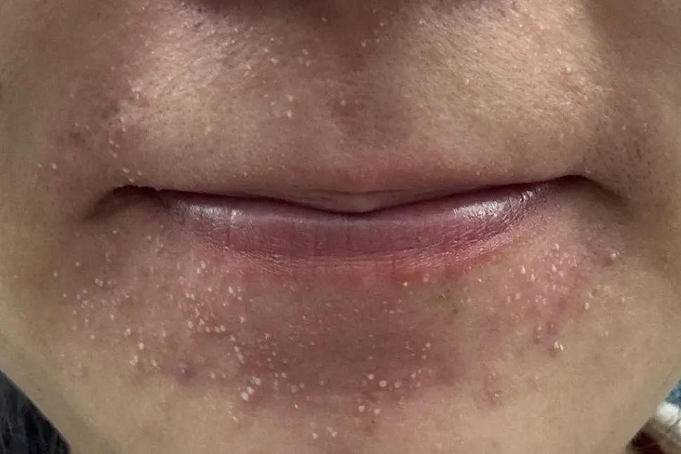 近期高发!这种小红疙瘩奇痒难耐,很多人却错把它当痘痘治,白白遭罪(组图) - 6