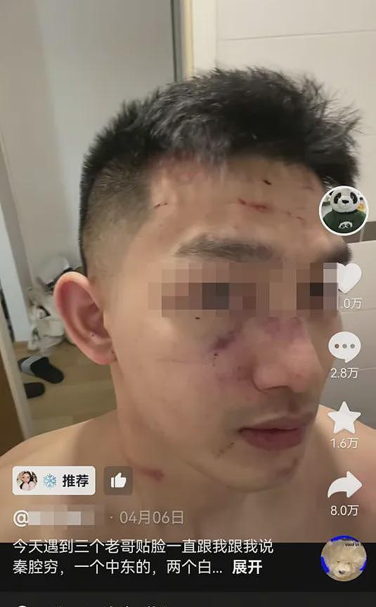 后续!中国学生遭留学生群殴!施暴者身份曝光引争议,被打男生恐毁容...(组图) - 10
