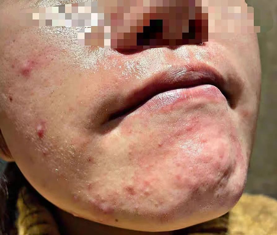 近期高发!这种小红疙瘩奇痒难耐,很多人却错把它当痘痘治,白白遭罪(组图) - 5