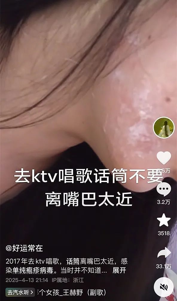 中国妹纸发视频引中美网友一片惊恐！就因KTV唱歌话筒太靠近脸，她从此染上“不治之症”8年后仍被折磨（组图） - 1