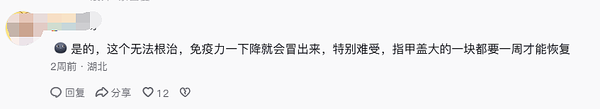 中国妹纸发视频引中美网友一片惊恐！就因KTV唱歌话筒太靠近脸，她从此染上“不治之症”8年后仍被折磨（组图） - 23